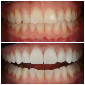 before-after photo viniry-emax