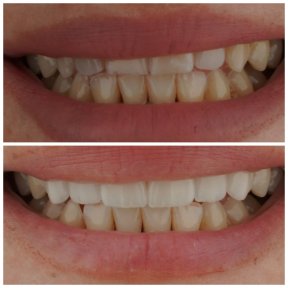 before-after photo viniry-emax