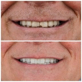 before-after photo installation-of-a-veneer