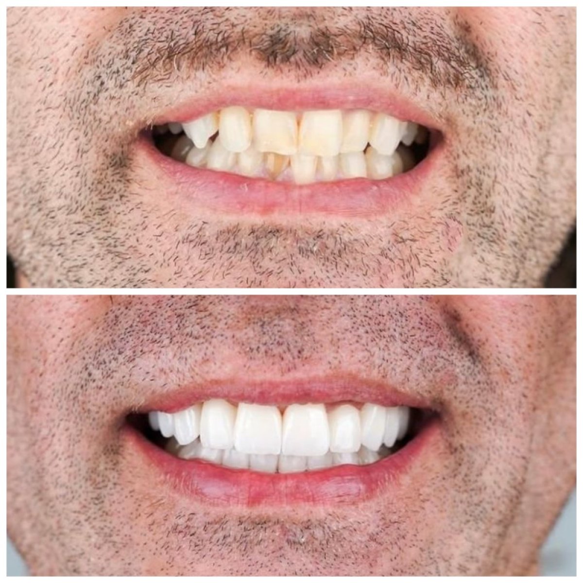 Antes y después de carillas dentales en Nifa Dent International – sonrisa natural