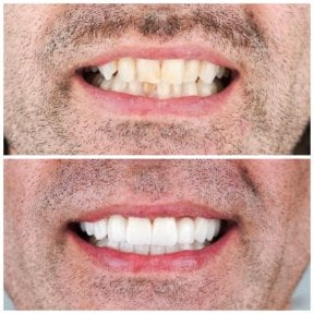 before-after photo installation-of-a-veneer