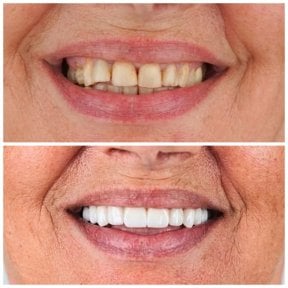 before-after photo installation-of-a-veneer