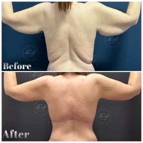 before-after photo arms-plastics-brachioplasty