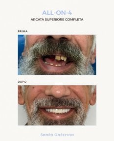 Before and after All-on-4 dental implants result at Santa Caterina Clinic, full upper arch