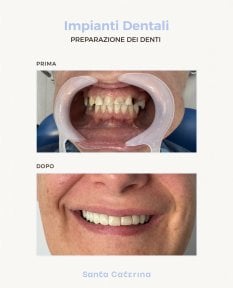 Before and after All-on-6 dental implants result at Santa Caterina Clinic Dental & Aesthetic Medicine