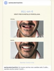 Before and after All-on-6 dental implants result at Santa Caterina Clinic, smile restoration