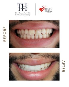 before-after photo zirconia-crown-installation
