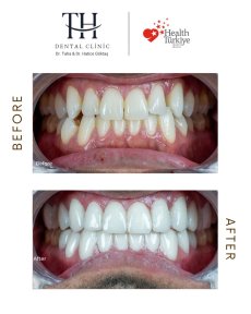 before-after photo zirconia-crown-installation