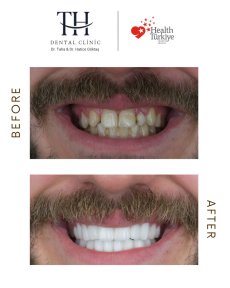 before-after photo zirconia-crown-installation