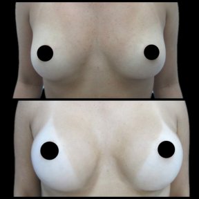 Before and after breast augmentation results – enhanced breast volume and contour