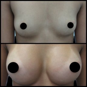 Before and after breast augmentation results – enhanced breast size and contour improvement