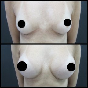 Before and after breast augmentation results – enhanced breast volume and contour