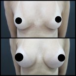 Before and after breast augmentation results – enhanced breast volume and contour
