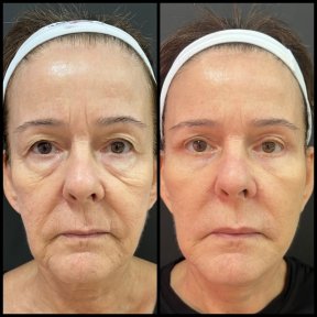before-after photo deep-plane-facelift