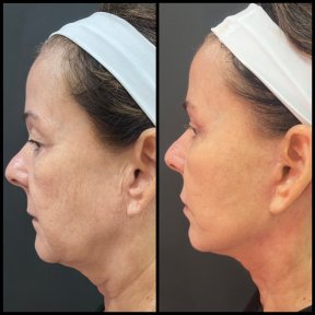 before-after photo deep-plane-facelift