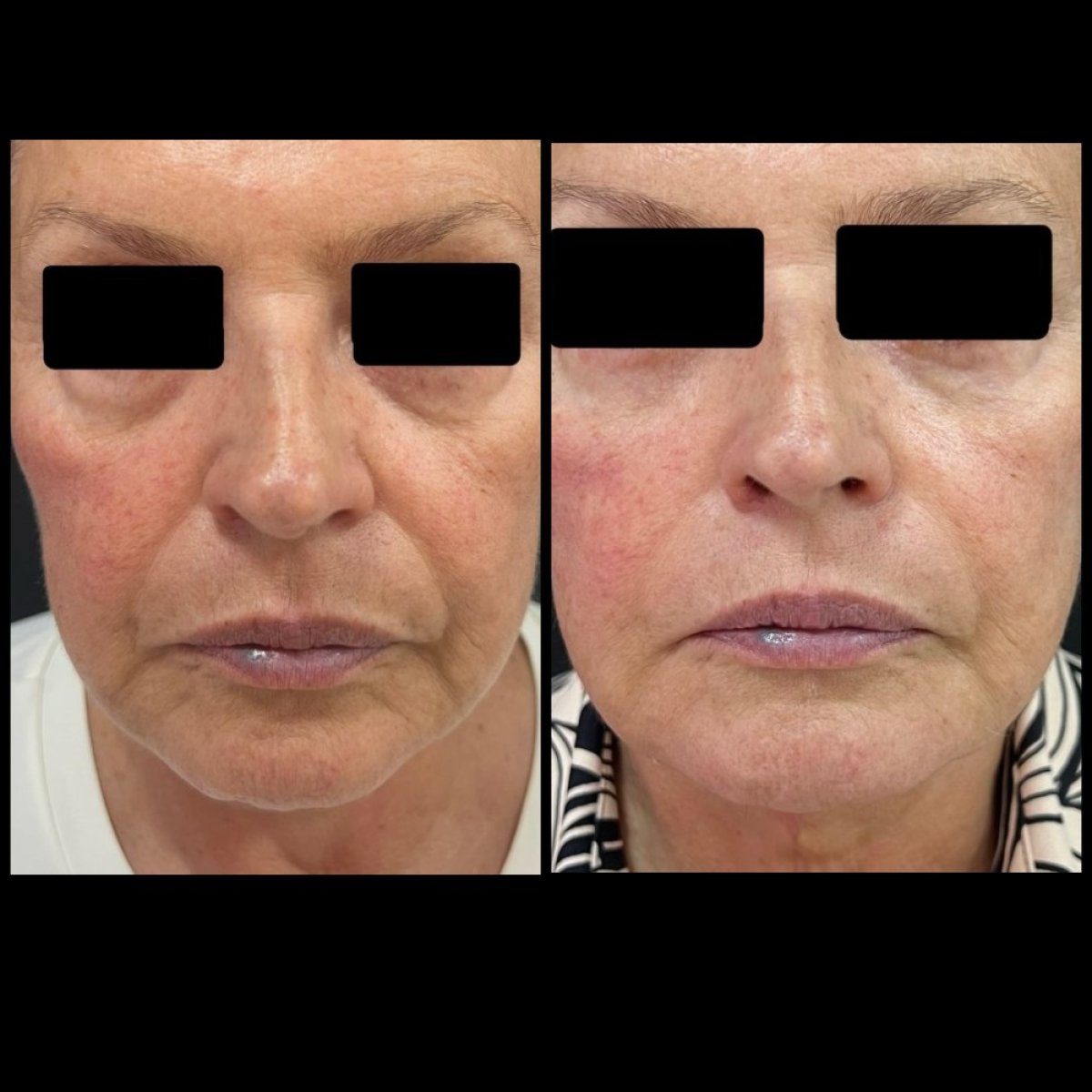 before-after photo