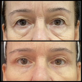 before-after photo blepharoplasty-eyelid