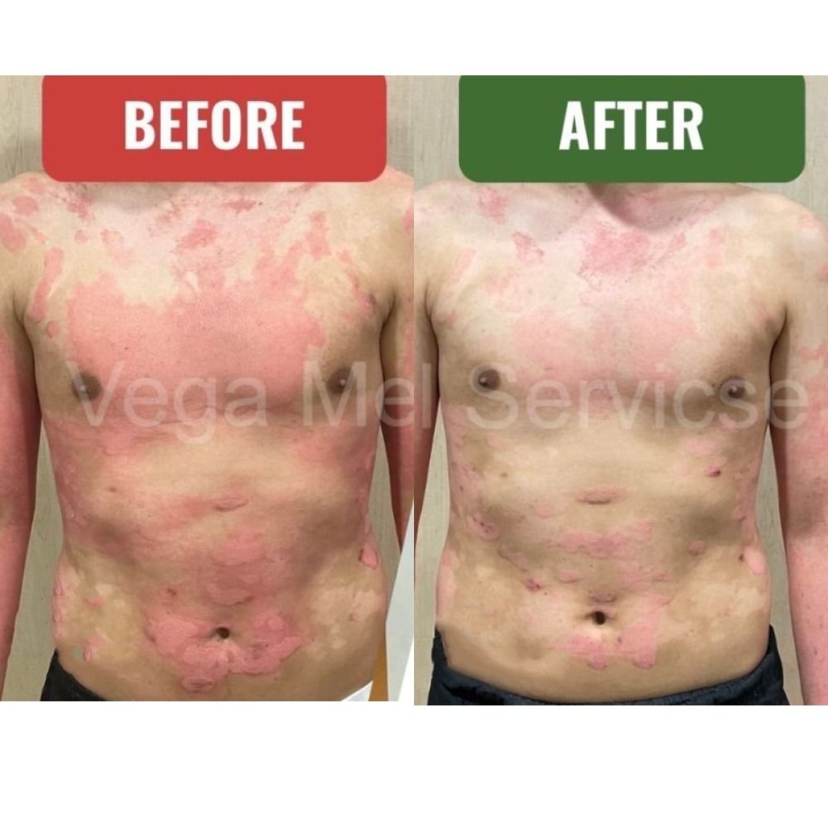 نتائج قبل وبعد علاج الصدفية بالخلايا الجذعية في Vega Clinic وتحسن ملحوظ للبشرة