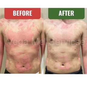 Before and after stem cell therapy for psoriasis at Vega Clinic, visible skin improvement result