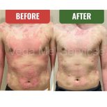 Before and after stem cell therapy for psoriasis at Vega Clinic, visible skin improvement result