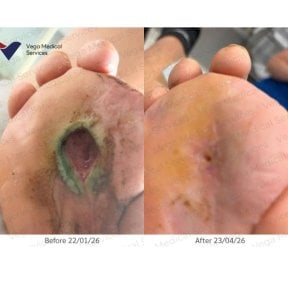 Before and after stem cell therapy for foot ulcer healing at Vega Clinic, visible recovery result