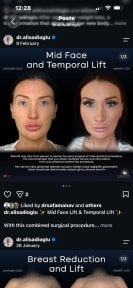 before-after photo tightening-of-facial-skin-facelift