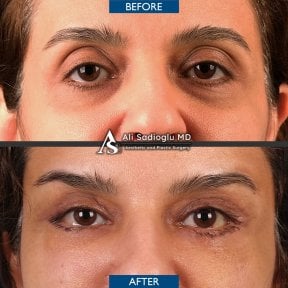 before-after photo tightening-of-facial-skin-facelift