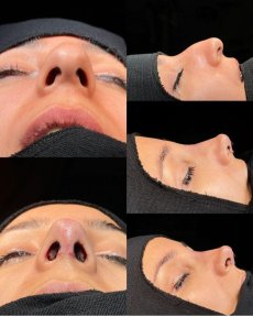 before-after photo rhinoplasty-nose-job