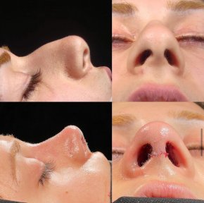 before-after photo rhinoplasty-nose-job