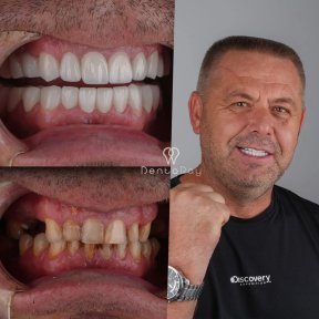 before-after photo dental-implant