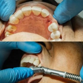 before-after photo dental-implant
