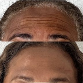 before-after photo botox-injections