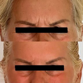 before-after photo botox-injections