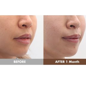 before-after photo lip-lift