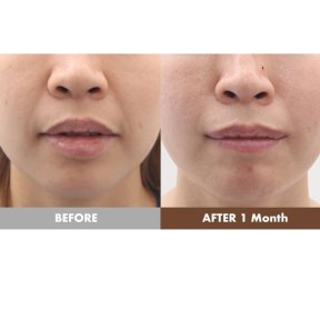 before-after photo lip-lift
