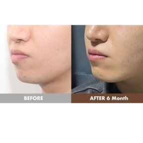 before-after photo lip-lift