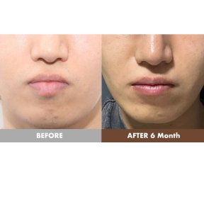 before-after photo lip-lift