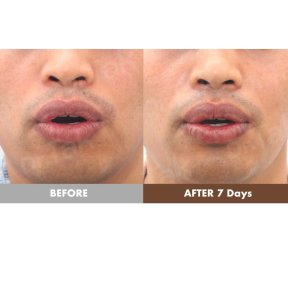 before-after photo lip-lift