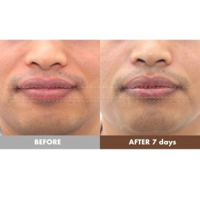 before-after photo lip-lift