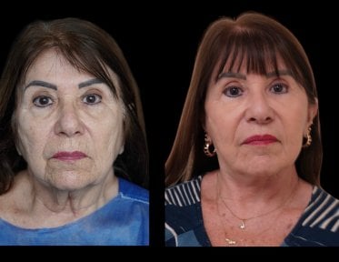 before-after photo blepharoplasty-eyelid