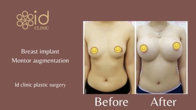 before-after photo breast-implant-revision