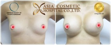 Before and after breast implant revision at Asia Cosmetic Hospital, improved breast shape result