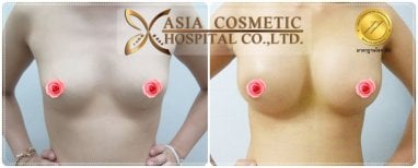 Before and after breast implant revision results at Asia Cosmetic Hospital, enhanced breast shape