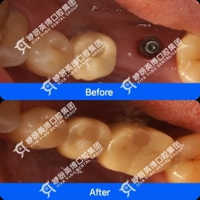 Before and after All-on-4 dental implant results at Wuhan Yiya Simei Dental Hospital