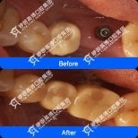 Before and after All-on-4 dental implant results at Wuhan Yiya Simei Dental Hospital