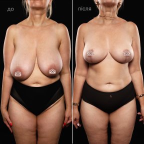 Before and after breast reduction results at Vidnova Clinic – improved breast shape and size