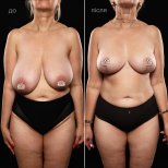 Before and after breast reduction results at Vidnova Clinic – improved breast shape and size