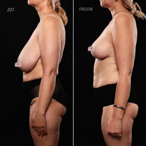 Before and after breast reduction results at Vidnova Clinic – improved breast contour
