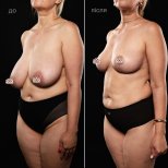 Before and after breast reduction results at Vidnova Clinic, improved breast shape and lift