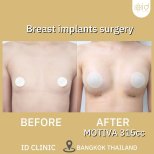 Before and after breast augmentation with Motiva 315cc implants at ID Clinic Bangkok results